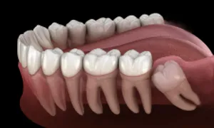 Vì sao con người có răng khôn? Vì sao con người có răng khôn?