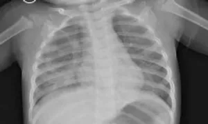 Bé trai một tuổi tổn thương phổi do uống nhầm dầu thắp đèn Bé trai một tuổi tổn thương phổi do uống nhầm dầu thắp đèn