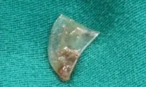 Mảnh nhựa cắm giữa hai dây thanh âm bé gái Mảnh nhựa cắm giữa hai dây thanh âm bé gái