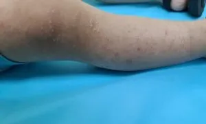 Bé trai bị viêm mô tế bào do viêm da cơ địa Bé trai bị viêm mô tế bào do viêm da cơ địa