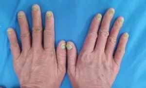 Liệu pháp ánh sáng điều trị vảy nến Liệu pháp ánh sáng điều trị vảy nến