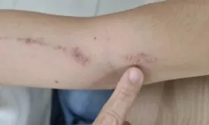 Viêm da cơ địa và tiếp xúc ở trẻ khác nhau thế nào Viêm da cơ địa và tiếp xúc ở trẻ khác nhau thế nào
